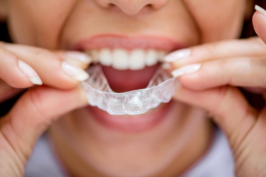 Woman putting in mouth guard