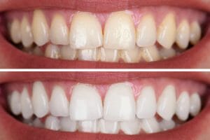Teeth whitening comparison of tow mouths side by side