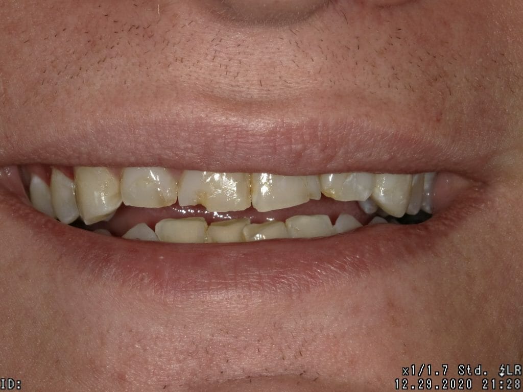 Close up of crooked teeth