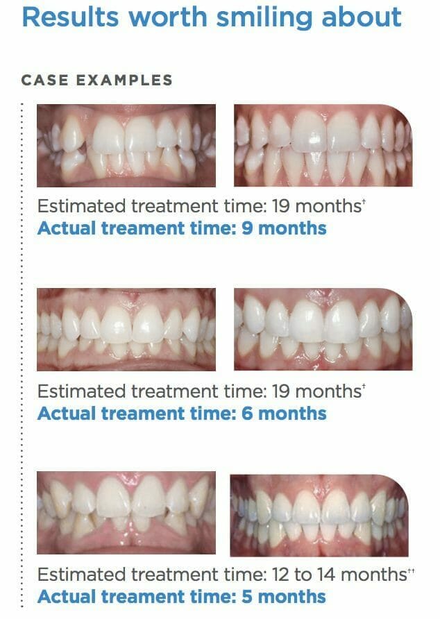 SureSmile Steps for straightening your teeth