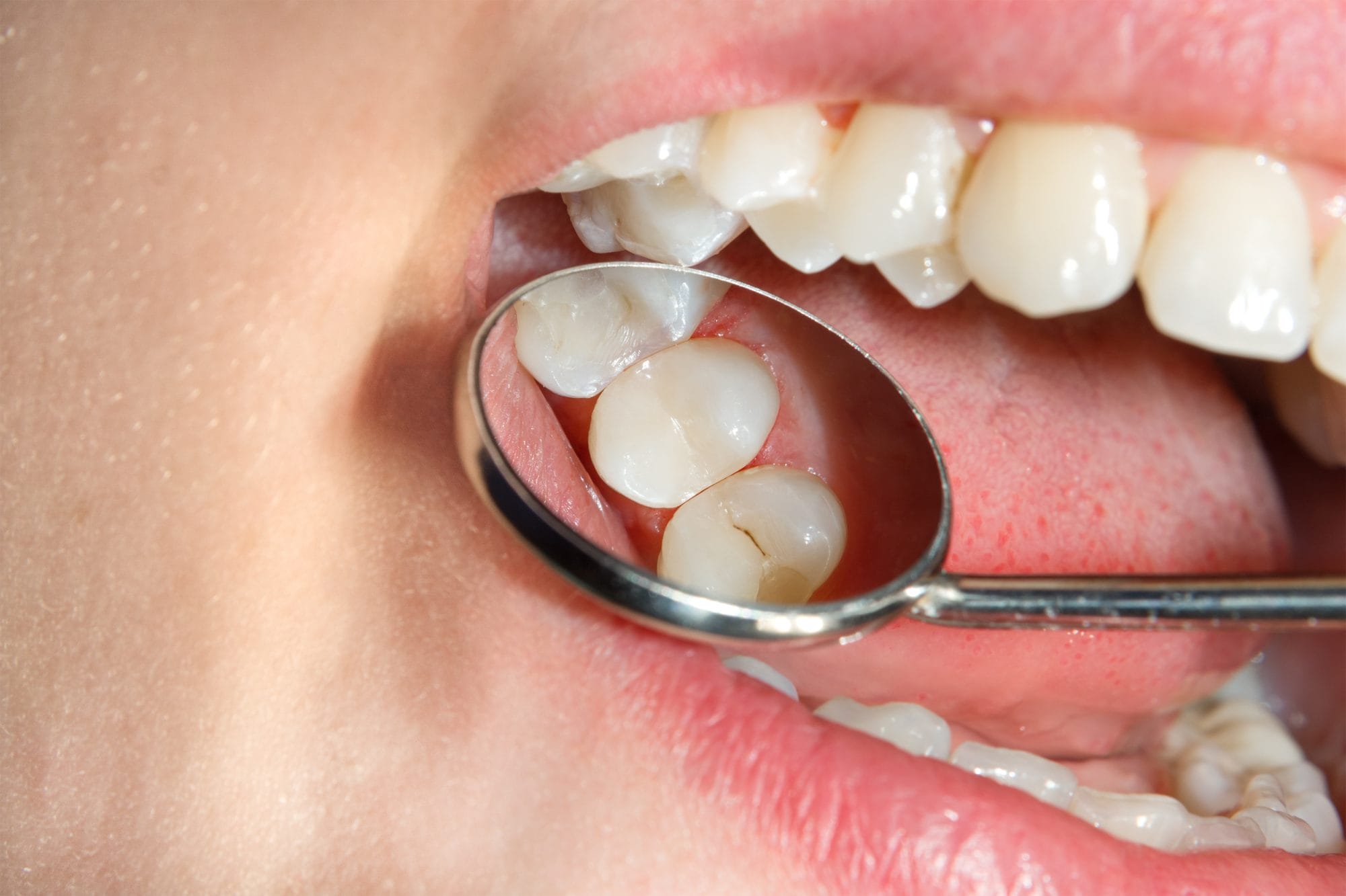 Seal the Deal on Cavity Prevention: Why Dental Sealants Aren’t Just for Kids