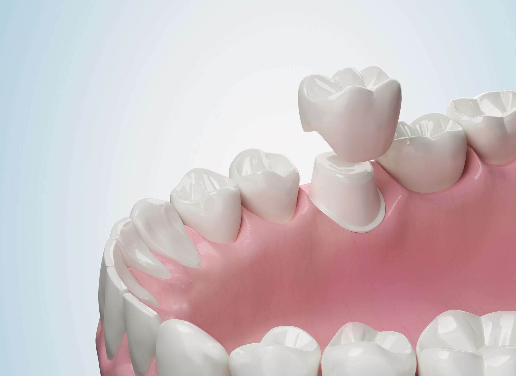 Cracked Tooth Season? How CEREC® Crowns Restore Your Smile in Just One Visit